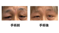 眼瞼下垂の術後
